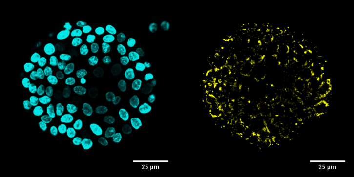 Rare disease reveals crucial factor for fat digestion