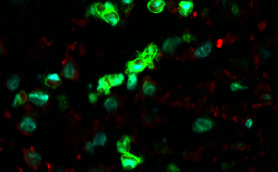 An unexpected developmental hierarchy in an unusual disease An unexpected developmental hierarchy in an unusual disease