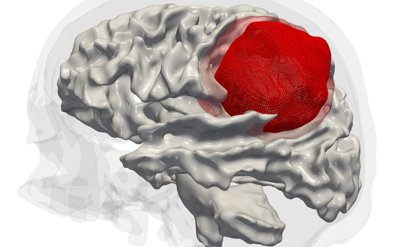 Epigenetic analysis of aggressive brain tumors Epigenetic analysis of aggressive brain tumors