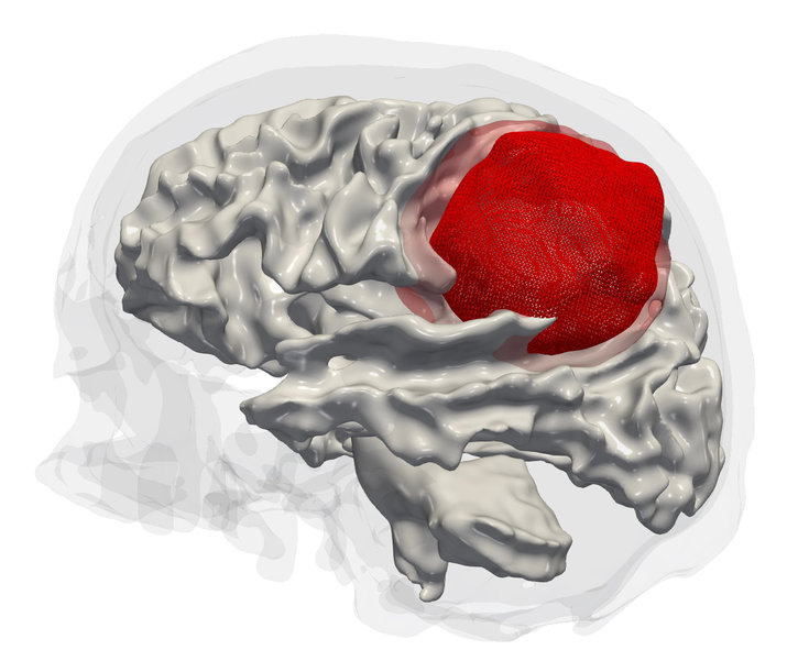 Epigenetic analysis of aggressive brain tumors
